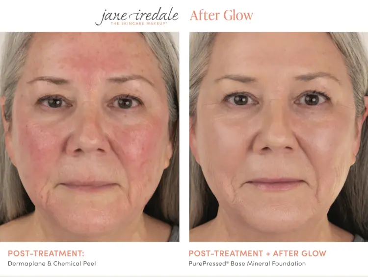 Porównanie efektu przed i po zastosowaniu makijażu Jane Iredale – After Glow. Po lewej skóra po zabiegu z zaczerwienieniem i podrażnieniem. Po prawej – wyrównany koloryt i wygładzone wykończenie dzięki kosmetykom.